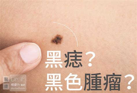 臉部黑痣|不大驚小怪！如何辨別「黑痣」與「黑色腫瘤」？ 